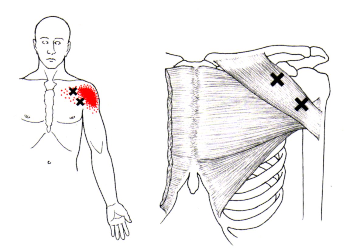 Pectoralis Major The Trigger Point Referred Pain Guide